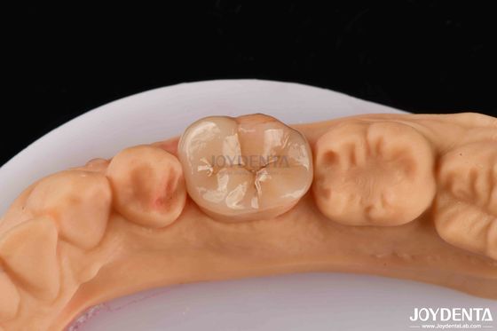 Alta resistenza dentaria Inlay Onlay composito aspetto naturale