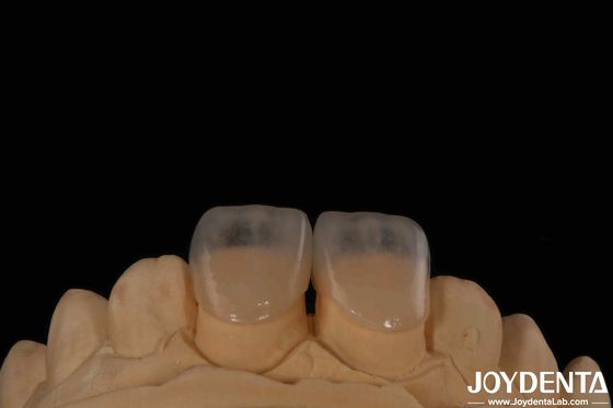 Eco-friendly Micro Dental Teeth Veneer 0.2mm Spessore Tessitura liscia