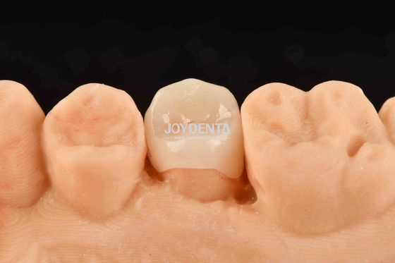 Personalizzabile Inlay Bianco Composito Inlay Onlay Naturale Aspetto Restituzione dentale minimamente invasiva