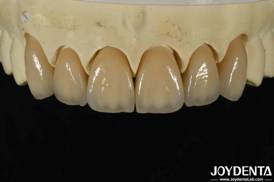 eccellente biocompatibilità zirconia stratificata con elevata estetica e densità 6,0-6,1 g/cm3