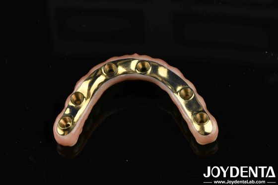 Ponte ibrido di zirconia in Ti-Bar su misura per comfort e durata nelle restaurazioni dentali