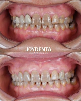 Circonia dentale leggera per un'esperienza ottimale del paziente Transizioni di colore naturali e biocompatibilità garantite
