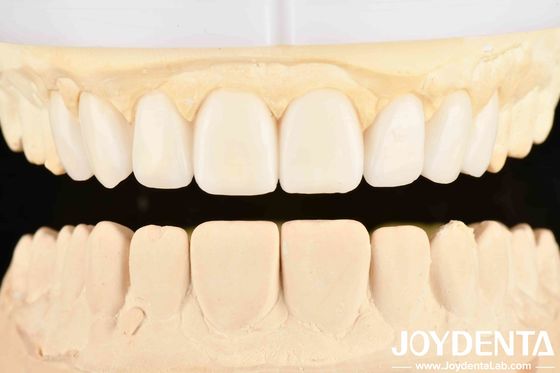 Dental's Good Elasticity And Tooth Arrangement Technology Finitura flessibile della protesi dentale nella cura dentale