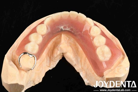 Metalli e resine Quadro di finitura dei denti per una struttura orale stabile nella configurazione dentale