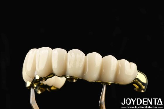 Confortevole da indossare Ponte ibrida in zirconia Ti-Bar ripristina la funzione masticatrice compatibile con denti e gengive naturali