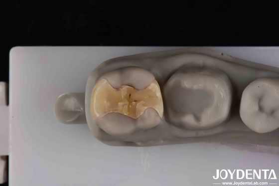 Cementatura sicura a bassa traslucidità per restauri estetici e di lunga durata
