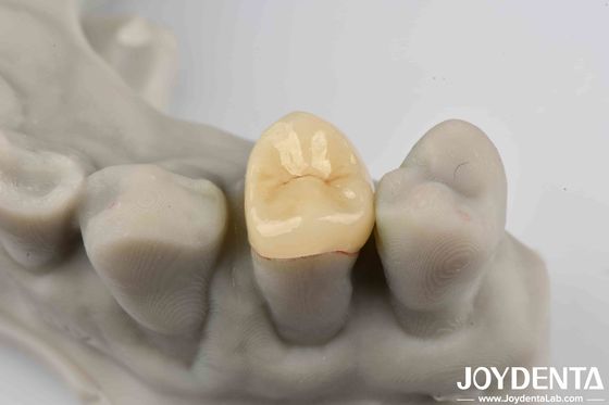 Cementamento sicuro Emax Inlay Onlay facile da pulire e resistente alle macchie