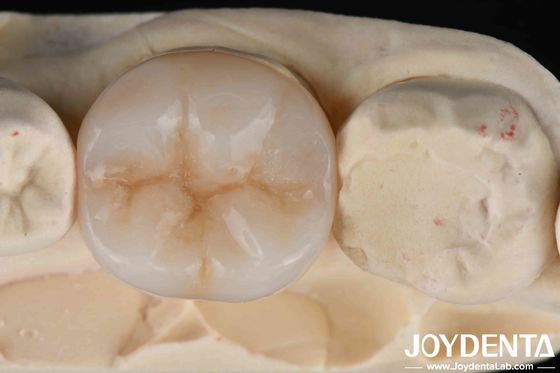 Multilayer Full Zirconia combinazione definitiva di forza ed estetica per la restaurazione dentale