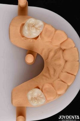 Estetica naturale con una combinazione vincente di zirconia dentale biocompatibile