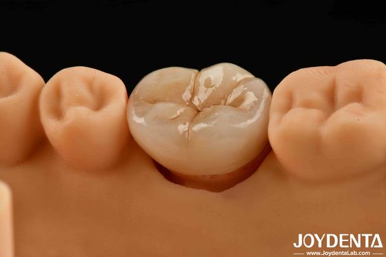 Circonia piena a più strati dall'aspetto naturale per alta resistenza e durata