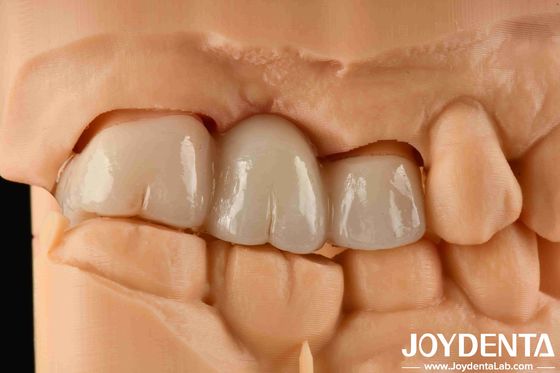 Esperienza colore realistica Zirconia piena con alta resistenza alla macchia e resistenza flessibile di 1000 MPa