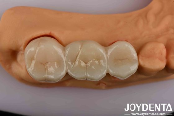 Circonia dentale ad alta resistenza la soluzione definitiva per un'estetica naturale