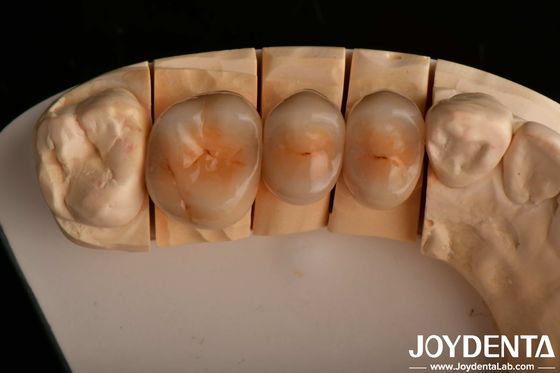 Alta resistenza al frantumamento e estetica naturale con la tecnologia multilivello full zirconia