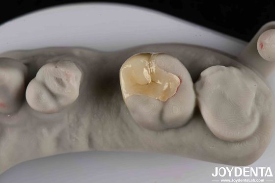 Forte resistenza alle fratture Emax Inlay Onlay estetica e durata naturale