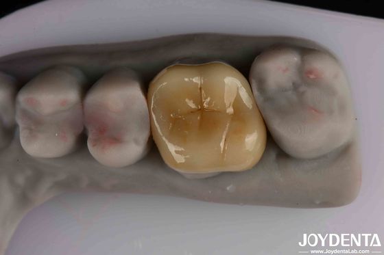 Facile da pulire e resistente Emax Inlay Onlay Resistenza alla colorazione per prestazioni ottimali