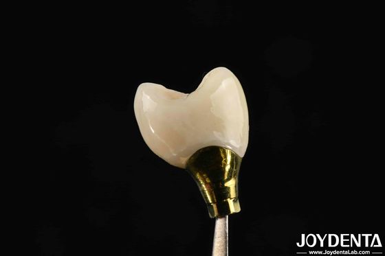 Diverse dimensioni corona e ponte per impianti dentali forti Compatibilità
