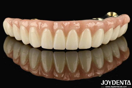 Ponte ibrida di zirconia in Ti-Bar compatibile con denti e gengive naturali Autobiografia ripristinare la funzione masticatrice
