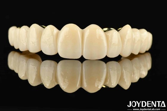 Ponte ibrido di zirconia in Ti-Bar fatto su misura la combinazione perfetta di comfort e funzionalità