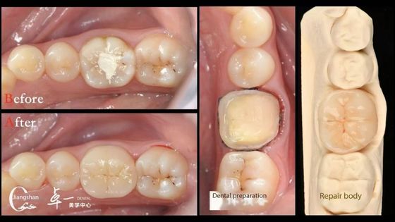 Biocompatibilità e alta compatibilità con i denti naturali Restaurazione dentaria