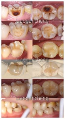 Intaglio dentale di porcellana per adulti e bambini prestazioni eccezionali