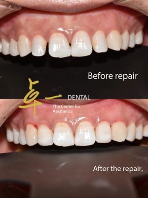 Di'ciao a un sorriso impeccabile con facciate cosmetiche dentali senza decolorazione, senza preparazione.