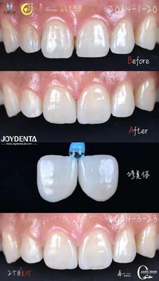 Indicazione dei denti anteriori Finiture dentali senza necessità di preparazione e senza decolorazione