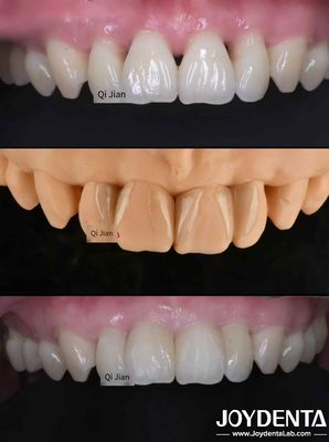 I rivestimenti per denti di scimmia: la soluzione perfetta per i rivestimenti dentali di trasparenza naturale