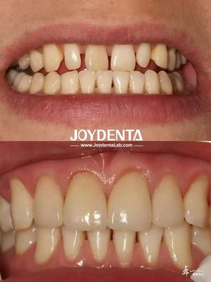 Finestre dentali durevoli senza sbiadimento Perfetto per le esigenze di approvvigionamento B2B e altro