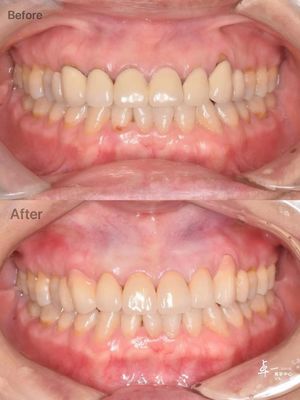 Circonia dentale ad alta resistenza alle fratture per tessuti orali sicuri e compatibilità CAD / CAM