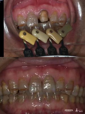 Corone di zirconia traslucidità Tecnologia a gradiente a più strati per ottimale traslucidità e biocompatibilità a lungo termine