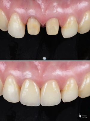 Le finiture sono realizzate con zirconia dentale resistente alle fratture e tecnologia a gradienti a più strati
