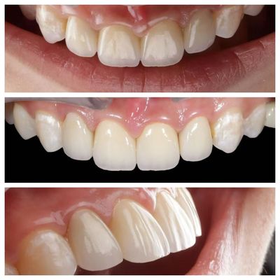 Indicazione dei denti anteriori Finiture dentali con spessore di 0,5 mm e perfetta permeabilità