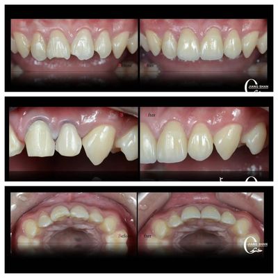 Finestre dentali naturali per un sorriso naturale e bello