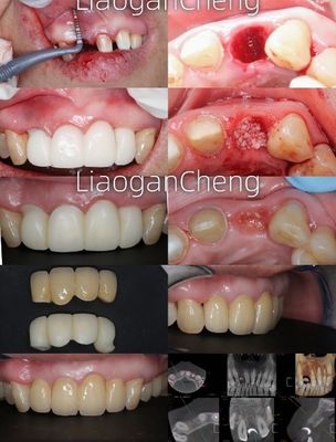 Tecnologia a gradienti multilivello Zirconia dentale sicura ed esteticamente piacevole a lungo termine