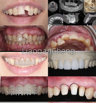 Biocompatibilità Corone dentali sicure in zirconia per restauri a lungo termine e con impianto