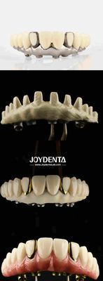 Dental Esthetic Titanium Malong Hybrid Bridge Soluzione definitiva per la restaurazione dentale
