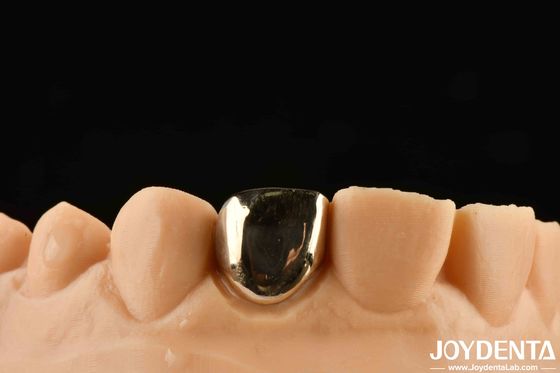 Esperienza riabilitazione orale come mai prima con Gold Crown Wax Casting