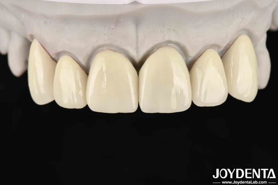 6.0-6.1 G/cm3 Densità di zirconia stratificata per alta traslucidità nella fresatura CAD / CAM