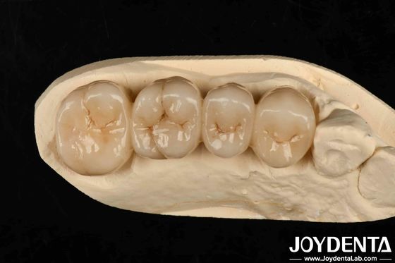 Multilayer Full Zirconia stile bianco con strati alta traslucidità alta resistenza alle crepe