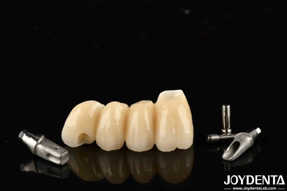Corona e ponte personalizzabili in porcellana per un funzionamento perfetto