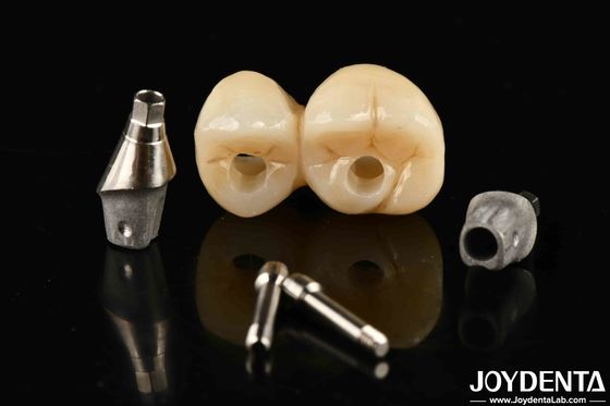 Impianto dentale in porcellana personalizzabile con ponte e corona per un'estetica eccezionale