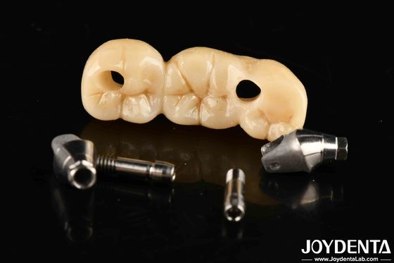 Implantazione corone e ponte perfetto per un'estetica piacevole