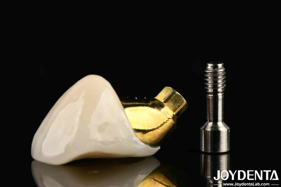 Implantazione a lunga durata corona e ponte per ripristinare i denti mancanti adatti agli impianti dentali