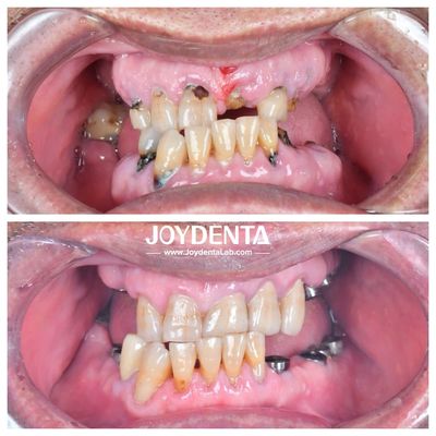 Resistenti all'usura e alla deformazione Corone dentali in zirconia Duratevoli e adatte per restauri posteriori e anteriori