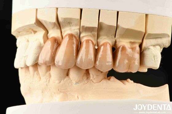 Denti bionici Zirconia stratificata con micro-incisione bionica delle foglie e laminazione biomimetica multicolore per simulazione avanzata della luce
