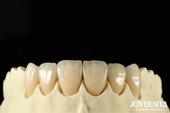 Sviluppo Bionico di Fogli e Strati Distinti di Zirconia All-Ceramica