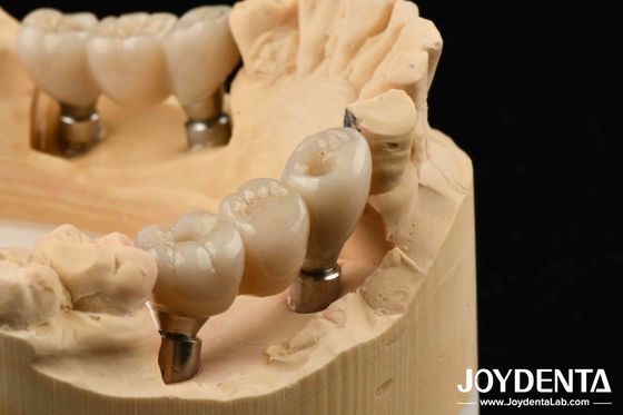 Implant Zirconia: Perfetta Armonia con i Denti Naturali, Rischio Allergico Zero