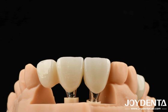 Impianti di zirconia di alta qualità per risultati estetici superiori Soluzioni sicure da allergie e resistenza di precisione