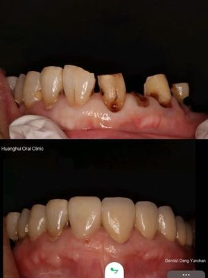 Corone di zirconia di prima qualità per i laboratori dentali globali.