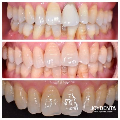 Corone Premium in Zirconio | Outsourcing Laboratorio Dentale Globale | JOY Dental Lab